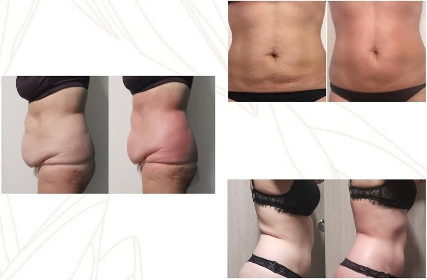 Avant/après d'une séance de Bioslimming Wrap sur le ventre