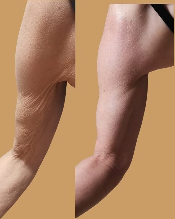 Avant/après des bras après 10 séances de Bioslimming Wrap